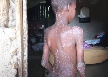 Une épidémie de gale fait rage en Haïti!