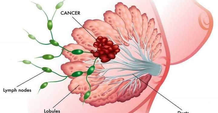 Le cancer du sein, une maladie qui ronge les femmes