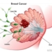 Le cancer du sein, une maladie qui ronge les femmes