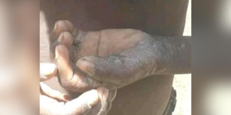 À Kenscoff, une maladie qui s’apparente à la gratelle terrorise la population