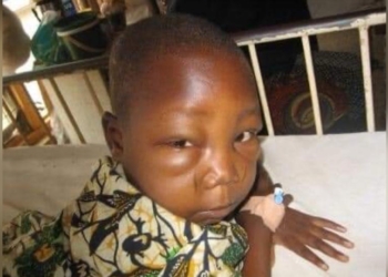 Yon maladi ki rele Glomerilonefrit egi kòmanse atake anpil timoun an Ayiti