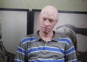 Le droit à la santé des Albinos mis entre parenthèses en Haïti