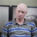Le droit à la santé des Albinos mis entre parenthèses en Haïti